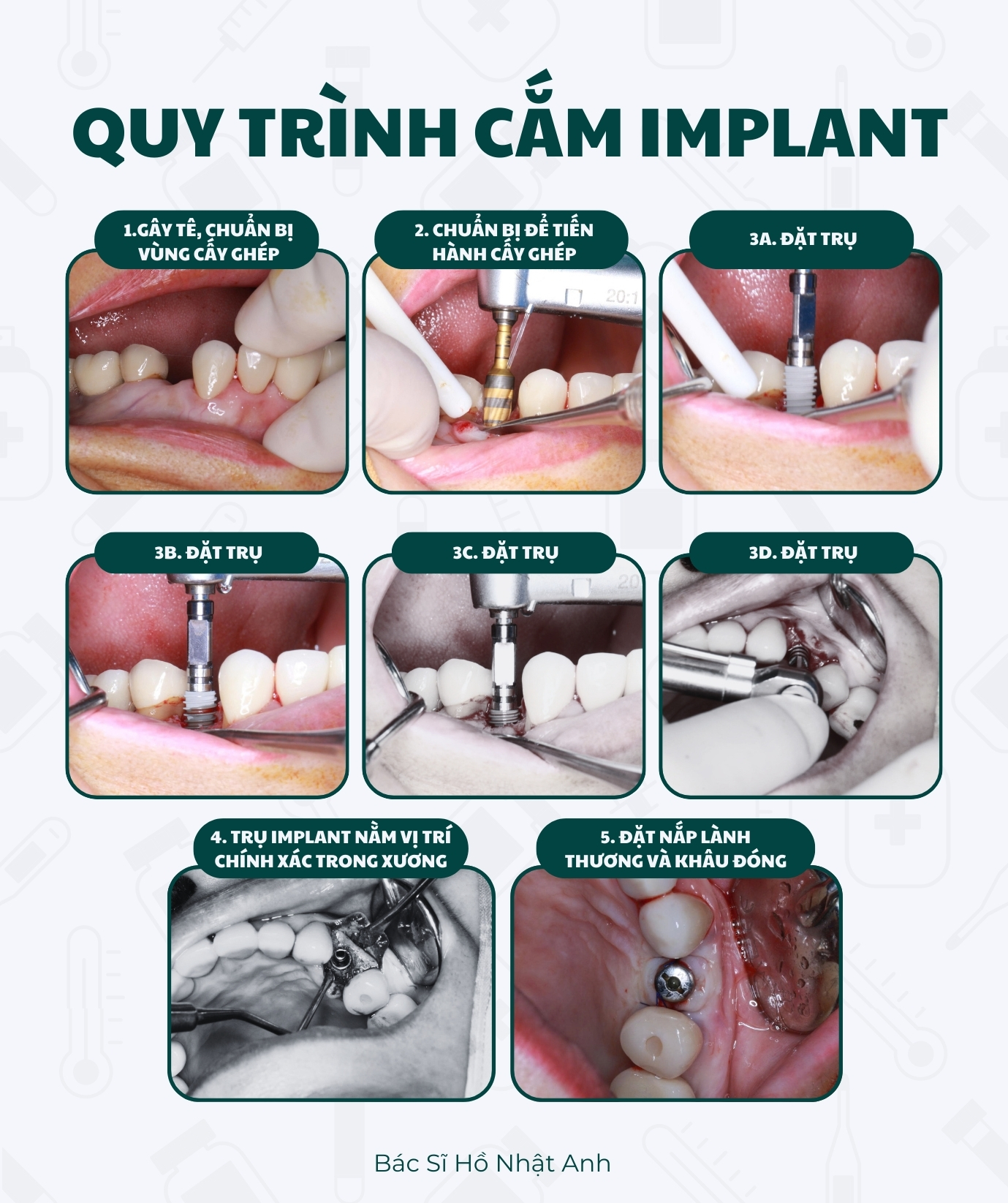 Quy Trinh CAM IMPLANT